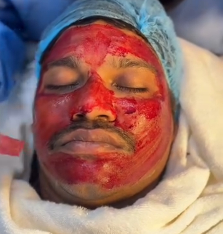 PRP Vampire Facial System