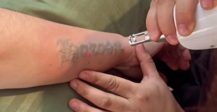 Tattoo Removal